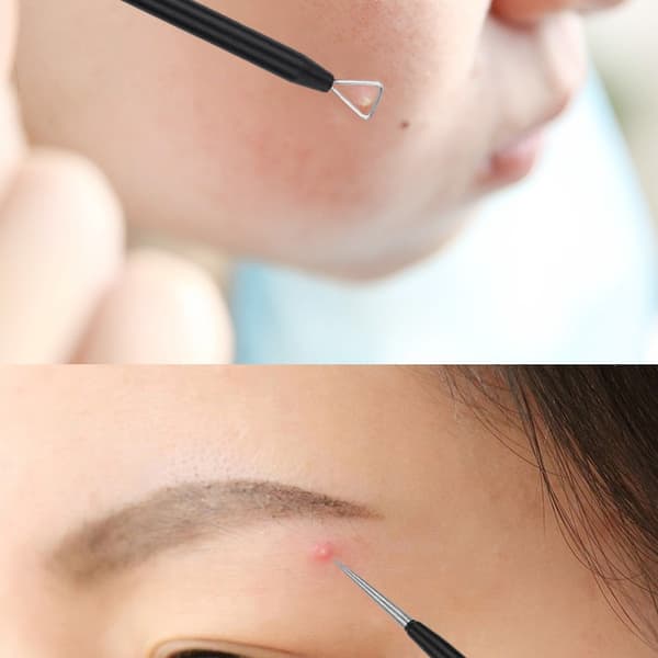 5 Pack Blackhead Remover Akne Needle Tools Kit Black