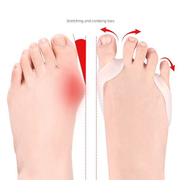 Tåudretter, Hallux Valgus Korrigerer til Storetå