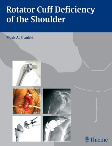 Rotator Cuff-defekt i skulderen