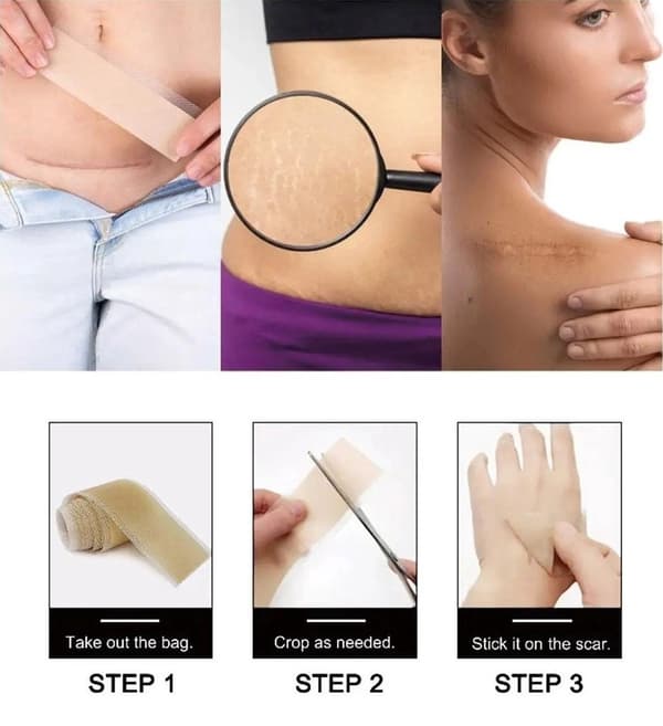 Silikontejp / Plåster för Ärr - Behandla ärr - 3-Pack