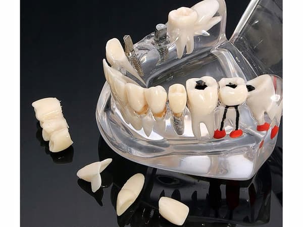 Dentalmodell 2 blå (100) GAB_B