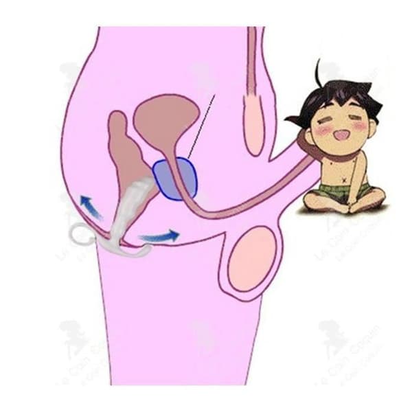 Plug - ANDERLEDES - Prostatamassager - Hvid - Prostatastimulator - Til mænd